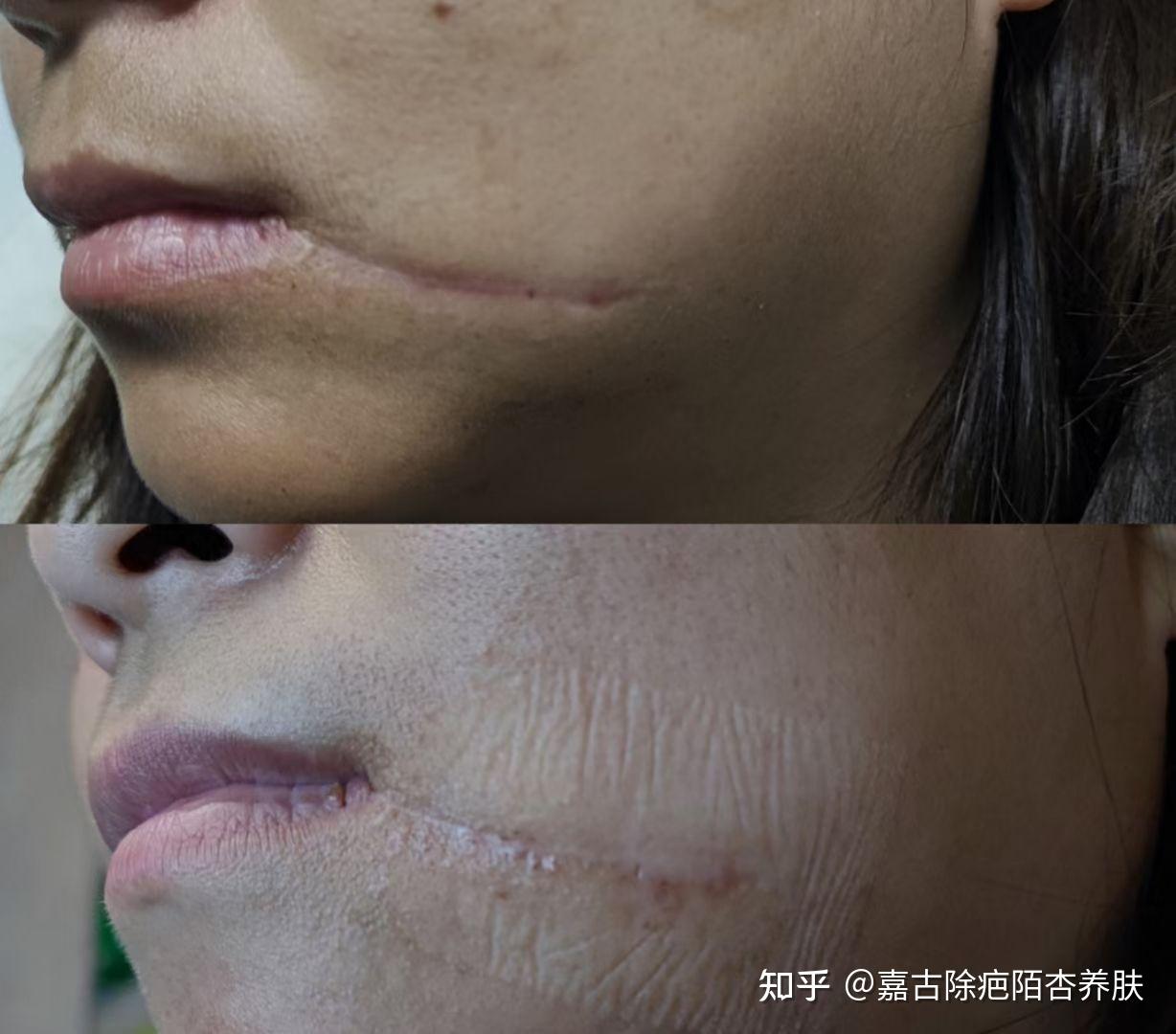 嘉古除疤 - 知乎