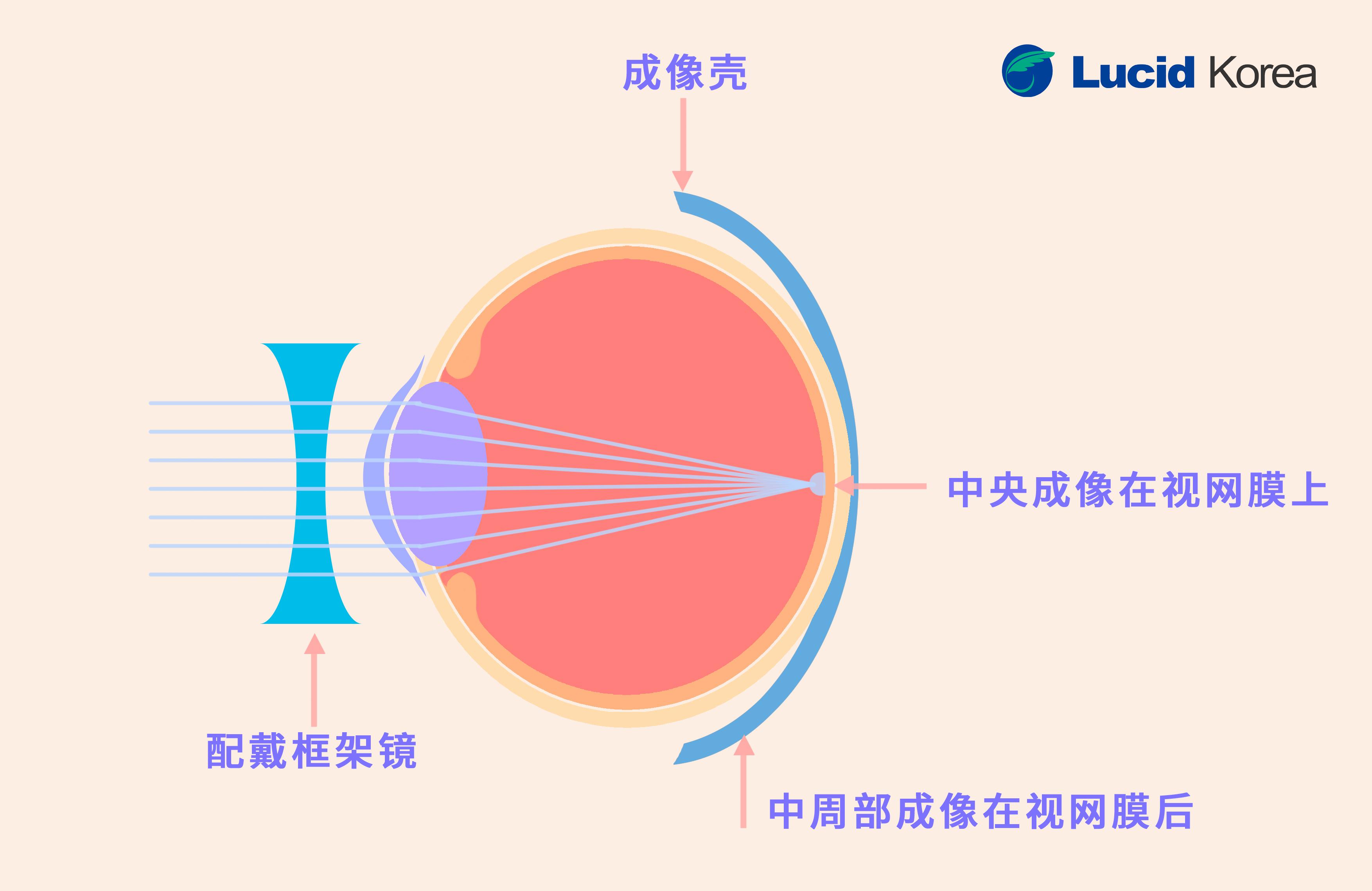给孩子配了OK镜的家长，这3件事你需要了解 | 露晰得问答 - 知乎