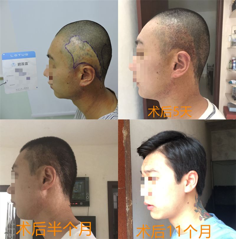头上疤痕可以植发遮住头皮吗 - 知乎