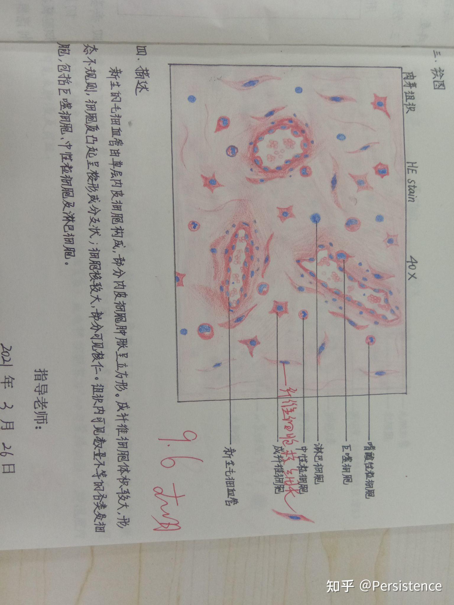 病理骨肉瘤红蓝手绘图片