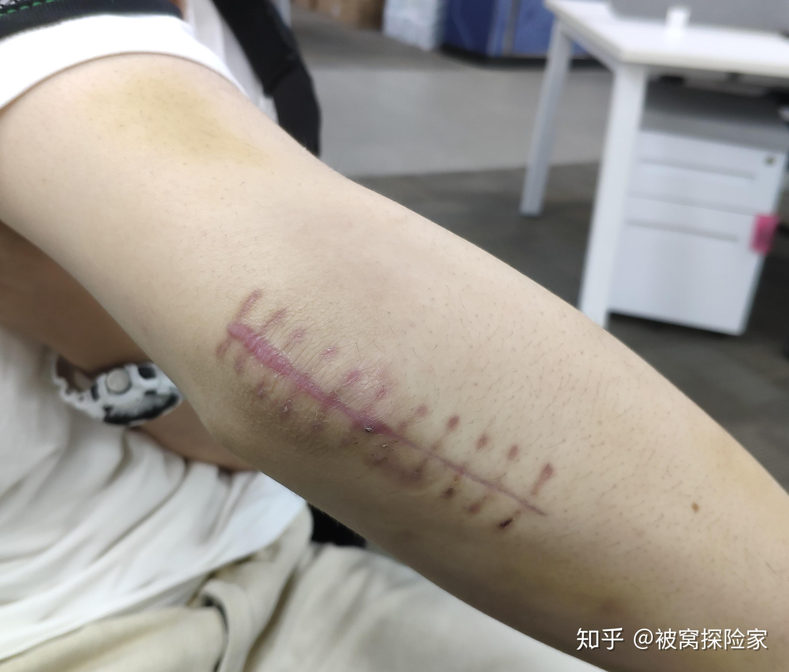 尺骨鹰嘴骨折