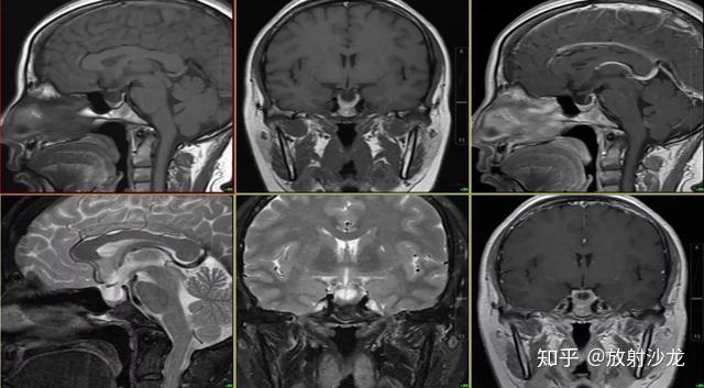 看完14个病例一起来认识这个表现多样的rathkes囊肿