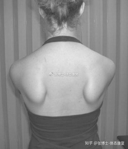 因为肩胛骨对你的姿势,上肢和肩膀的灵活性起重要作用