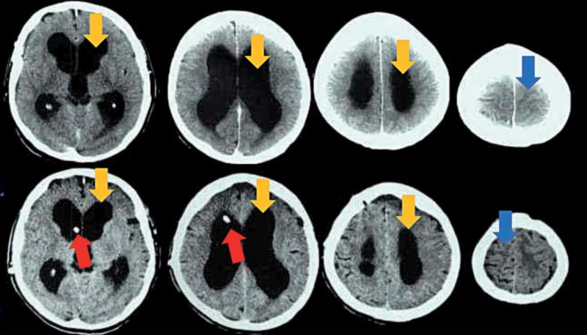 图4:正常压力脑积水患者脑脊液分流前后的头颅ct(分别为上,下两排)