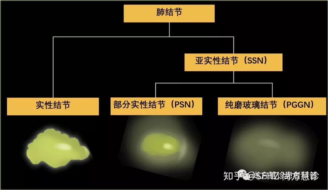 讀懂肺結節一肺結節定義分類惡性比例和風險因素