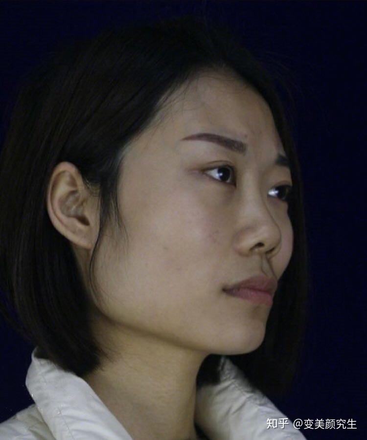 颧骨颧弓内推77下颌角整形