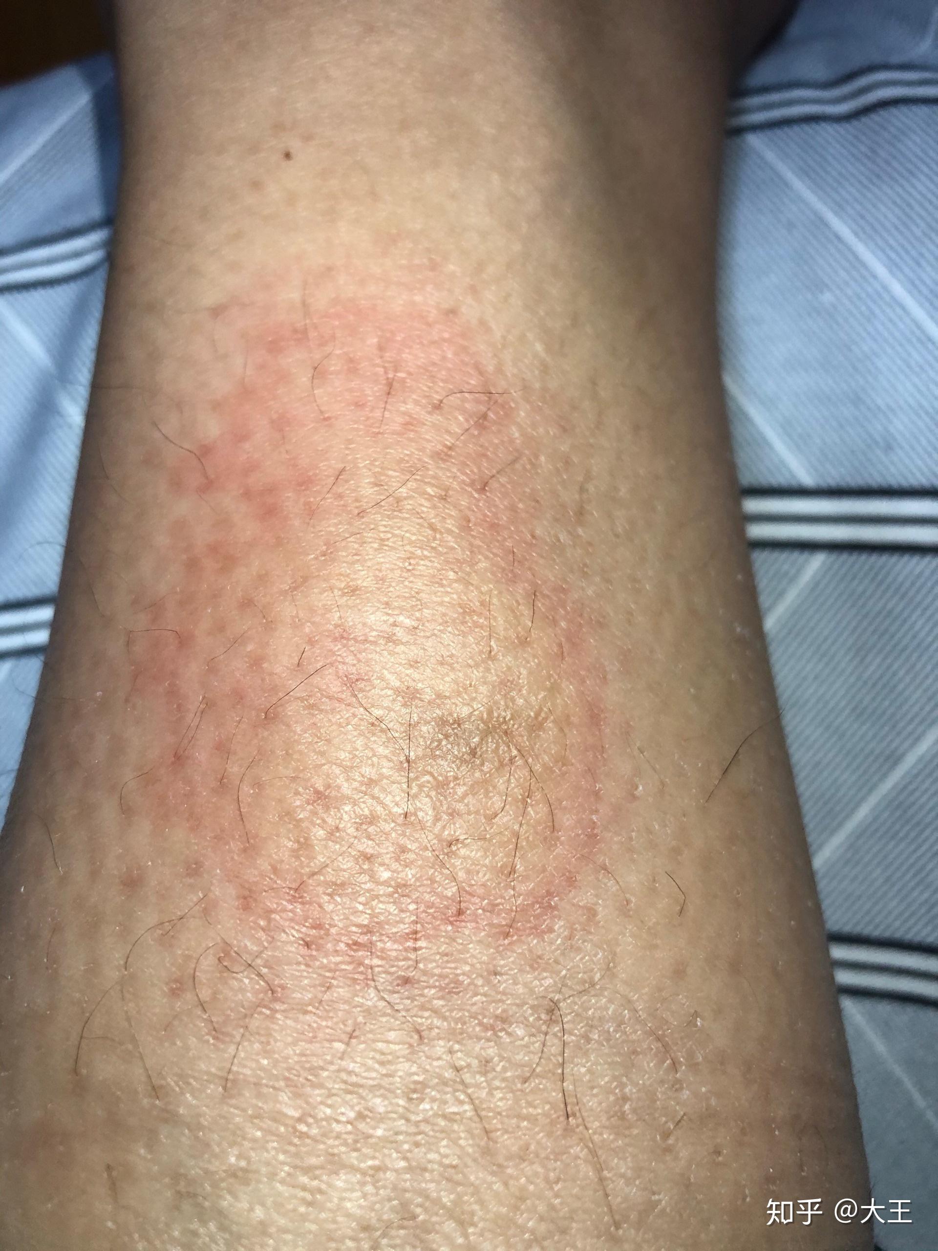 艾灸烫伤到感染起湿疹到清创恢复过程记录