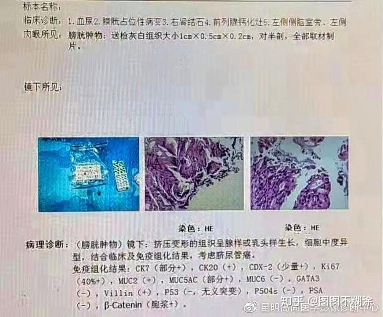 区及膀胱顶前壁软组织肿块,代谢增高,考虑脐尿管恶性肿瘤(脐尿管癌)
