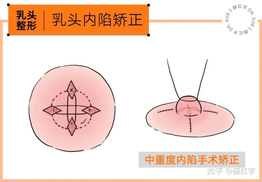乳晕缩小乳头内陷乳头缩短整形术