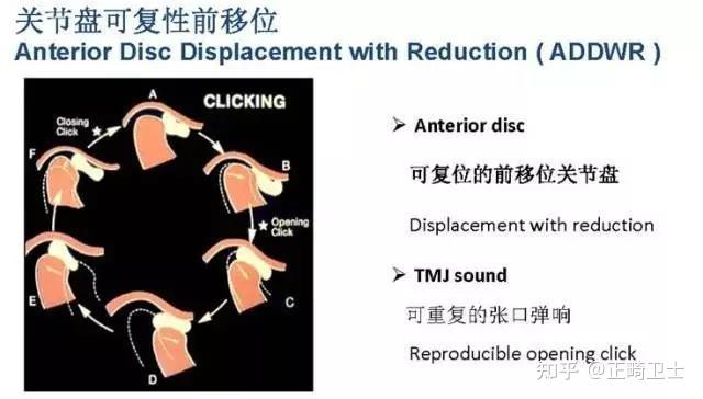 顳下頜關節盤移位的分期治療本文轉載自朱耀旻顳頜關節及頜面整形工作