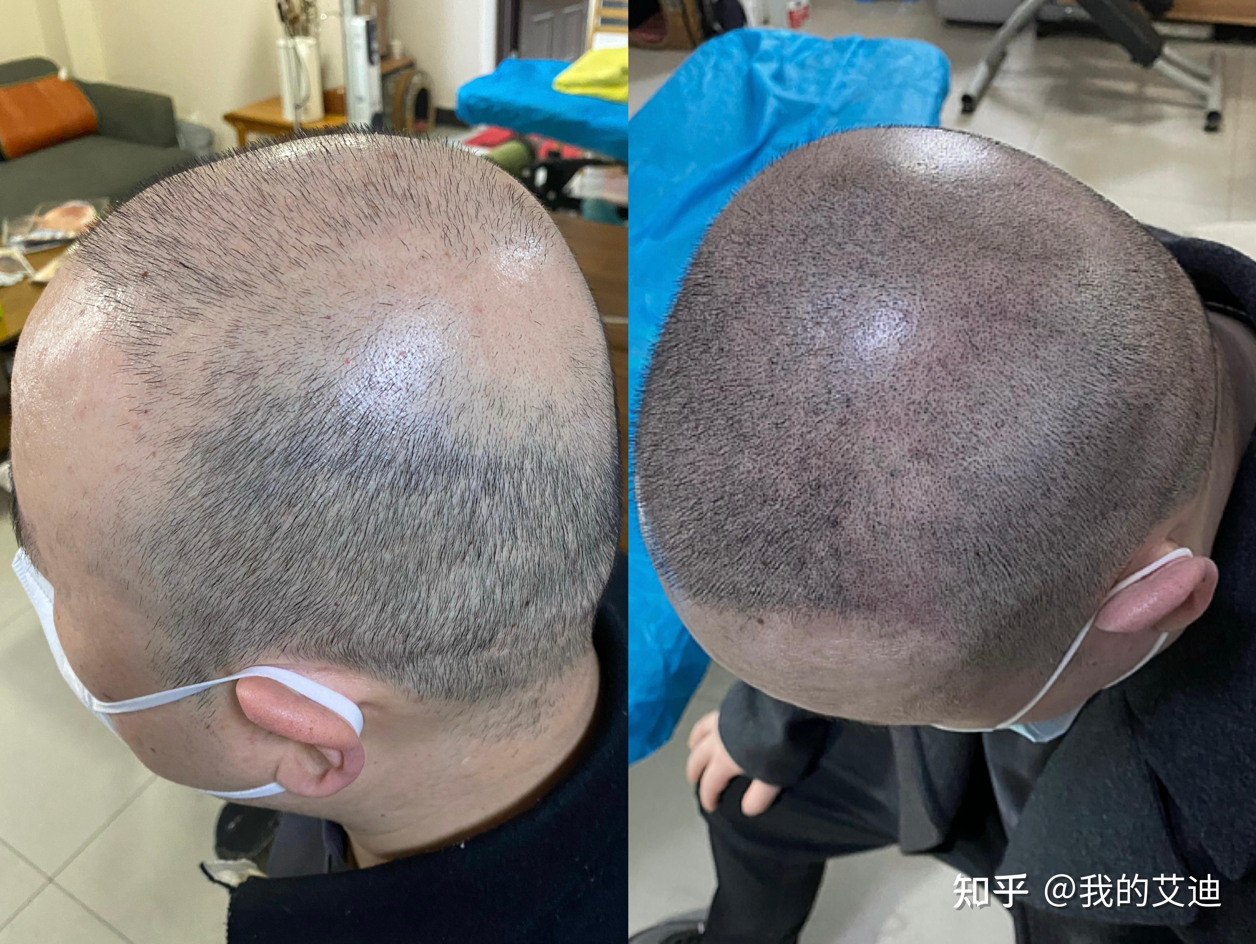 头发油腻脱发怎么解决纹发可以改善 - 知乎