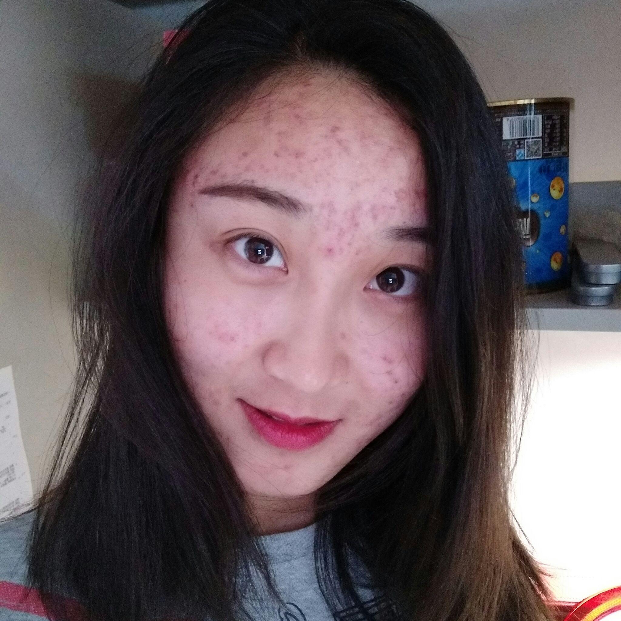 大家治痘痘都经历过哪些漫漫长路呢?怎么治痘