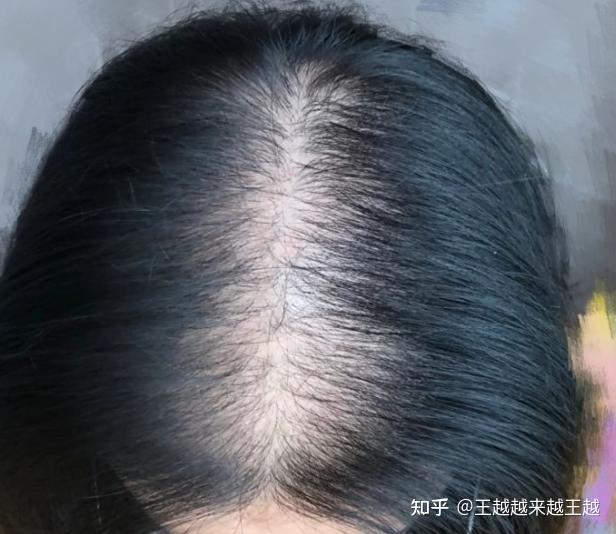 中西医结合诊疗雄激素性秃发专家共识