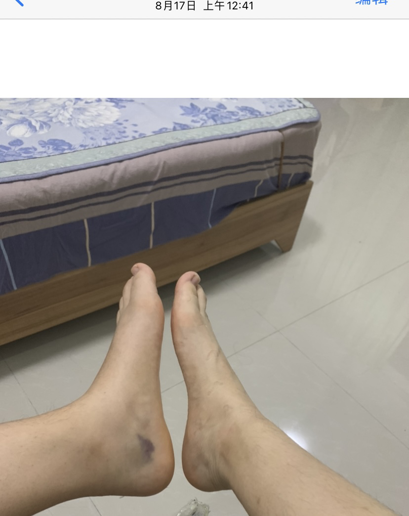 多图记录:撕脱性骨折恢复过程 - 知乎