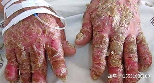 牛皮癣银屑病长什么样