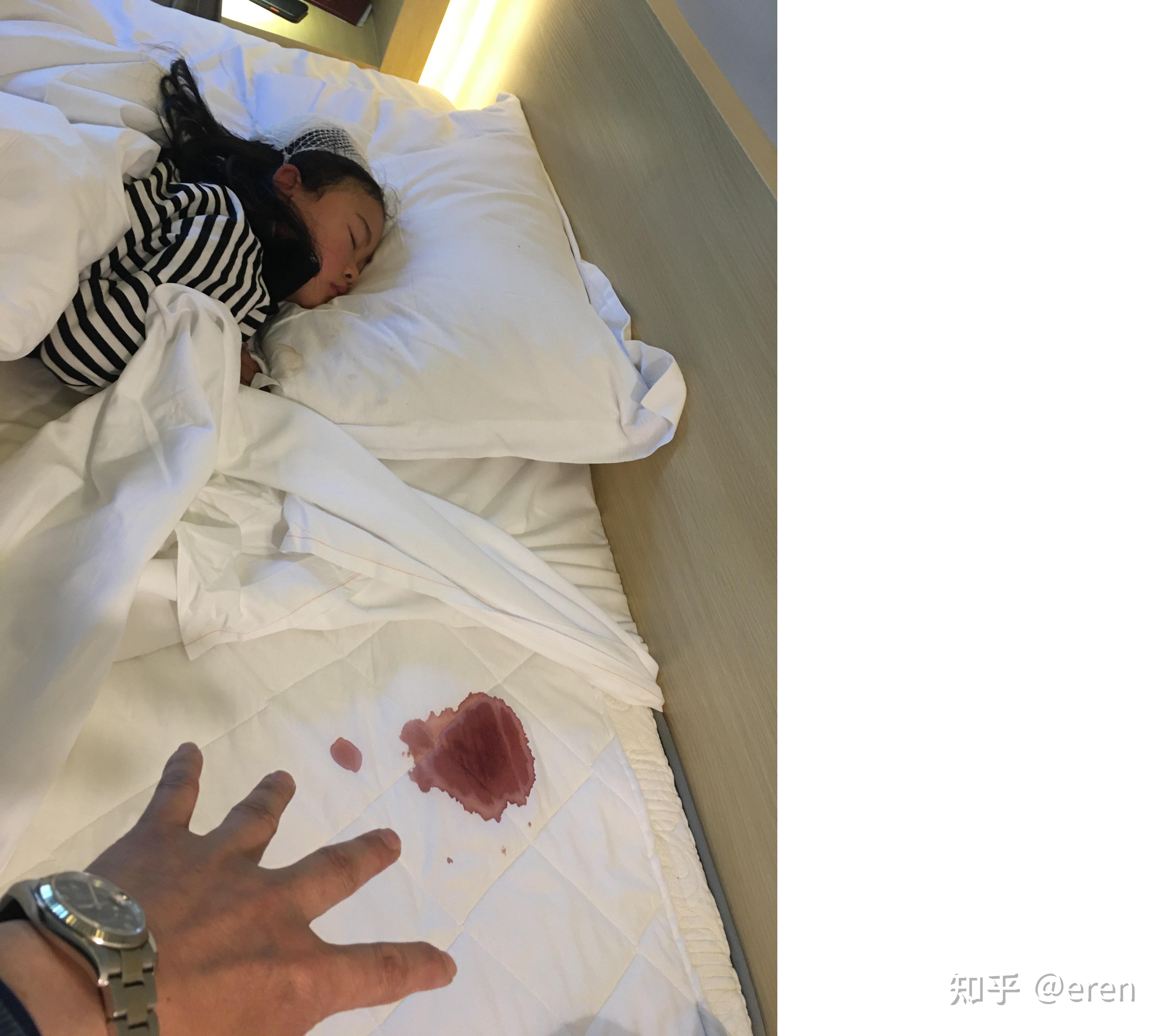 入住酒店磕破头缝六针请教总出血量约多少毫升