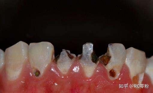 那些特别爱喝可乐的人他们的牙齿后来怎么样了