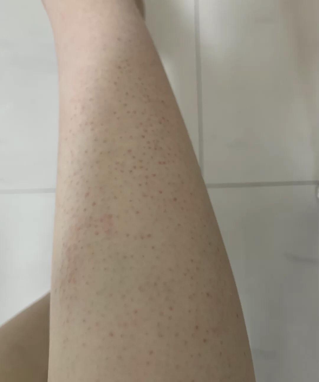 腿上有大面积的红色疹子 瘙痒 复发性强 看看有什么解决办法 有图片_百度知道