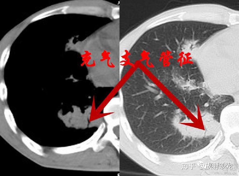 肺部wegener肉芽肿影像征象分析