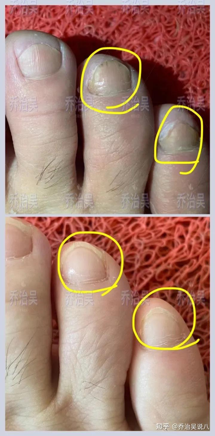 灰指甲怎么治疗步骤图片
