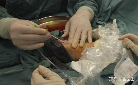 超声引导下经鼻烟窝处桡动脉远端穿刺行球囊扩张术治疗动静脉内瘘狭窄