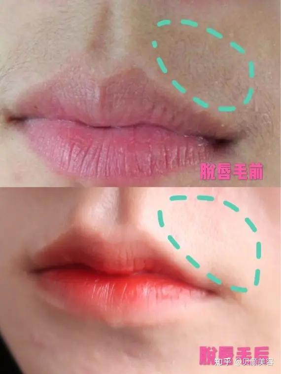 女生长唇毛也太尴尬了吧教你招方法去掉它
