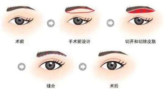 21变美指南 年前速美攻略之眼睛篇 知乎