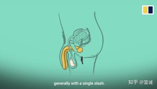 对被阉割者的阴茎连同阴囊进行切除,通常分两步:第一步第一步是割睾丸