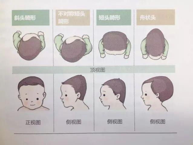 2个月宝宝总是向右偏头,是否斜颈?怎么干预?