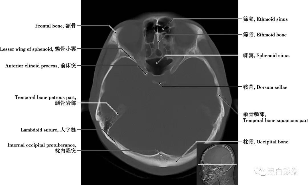 详细标注版!颅脑CT正常解剖图谱 - 知乎