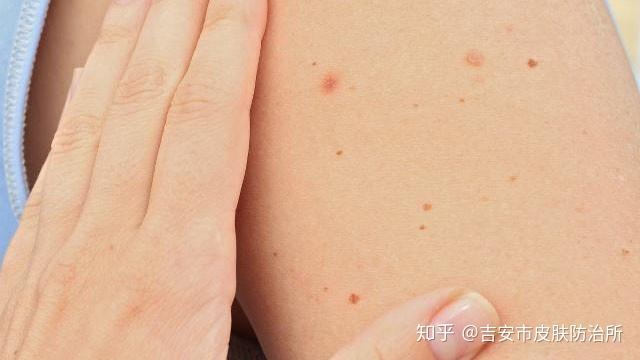 天气干燥如何改善烦人的鸡皮肤