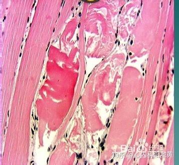 肥厚型心肌病 - 知乎