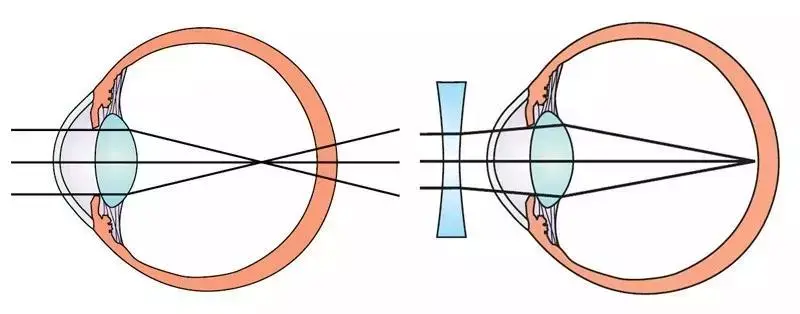 戴框架眼镜就是在眼前方放置一凹透镜,使光线发散,最终聚焦在视网膜上