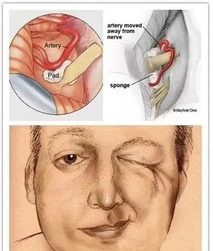 面部肌肉抽搐狂跳不停,可能是面肌痉挛?
