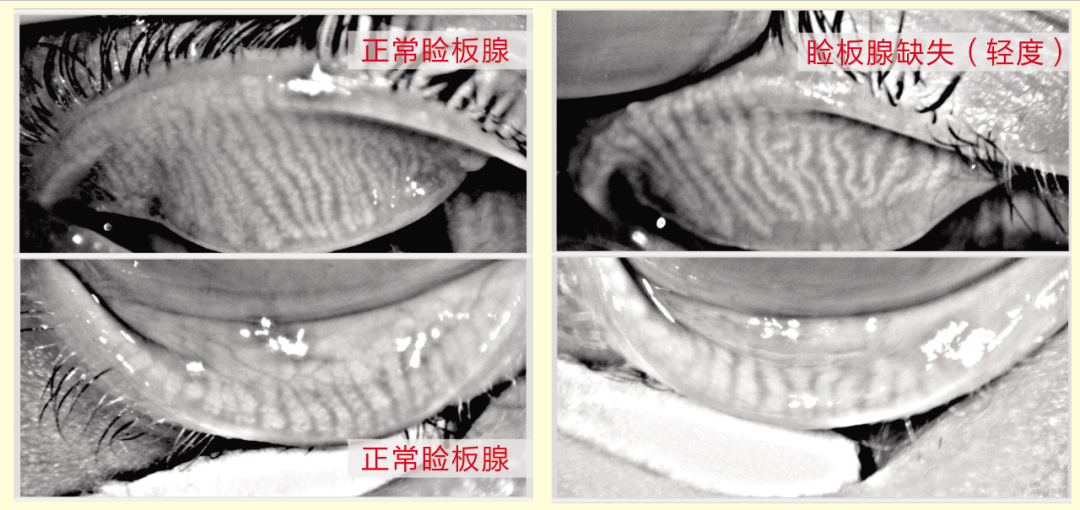 眼睛干涩、难受？试试干眼SPA理疗 - 知乎