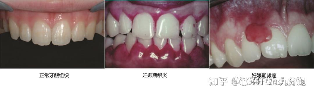 妊娠期龈炎妊娠性牙龈炎通常在妊娠第二个月晚些时候出现,在妊娠第八