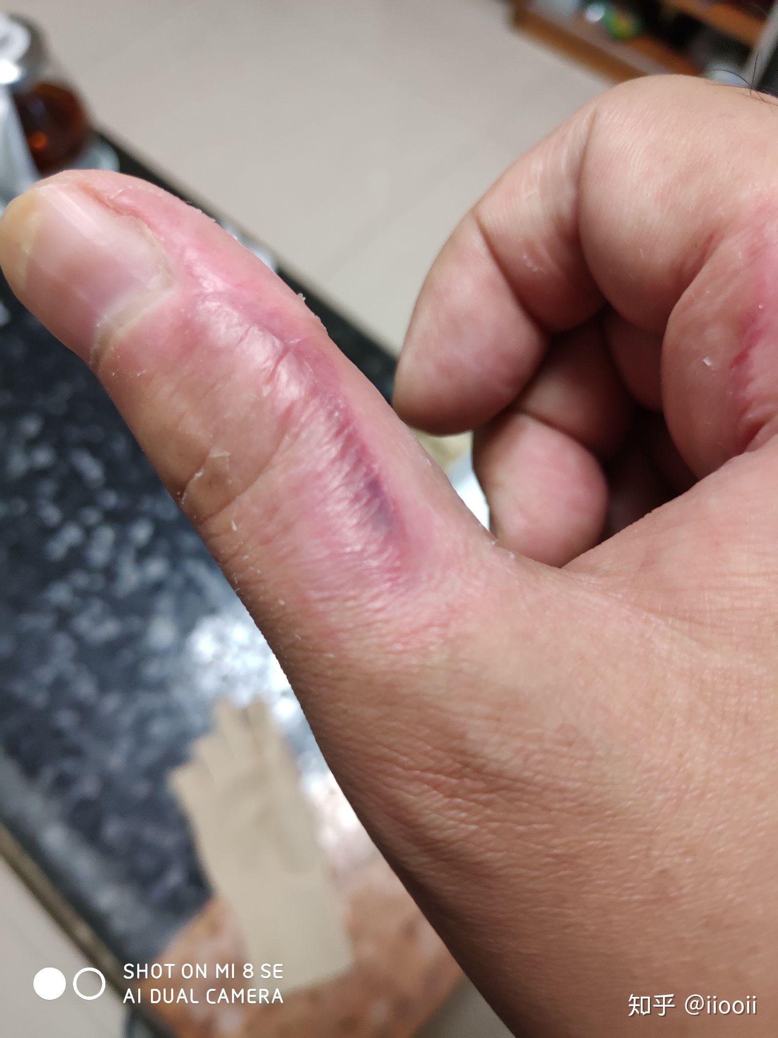 电弧烧伤疤痕增生抗疤治疗