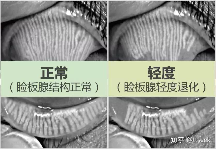 如何有效缓解视疲劳提高泪膜质量睑板腺按摩实操
