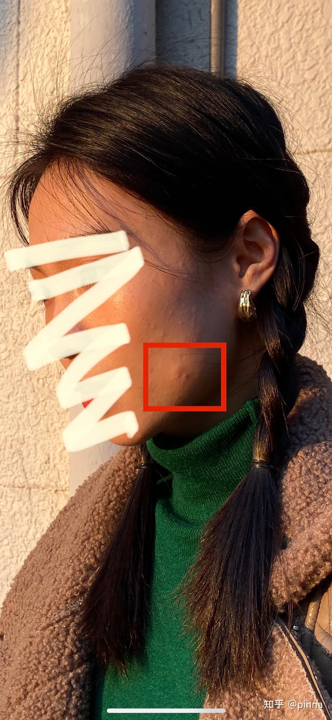 打完新冠疫苗第二针之后开始荨麻疹,皮疹