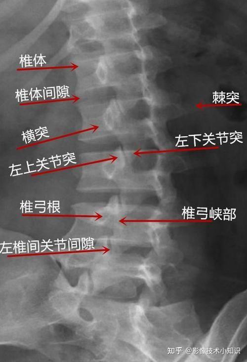 腰椎滑脱x线诊断图片