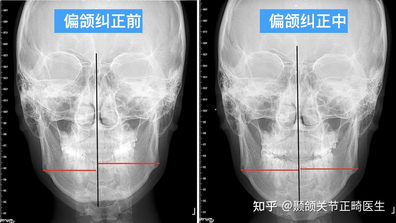下颚骨不对称可以经常撑着低的那边去改善吗?