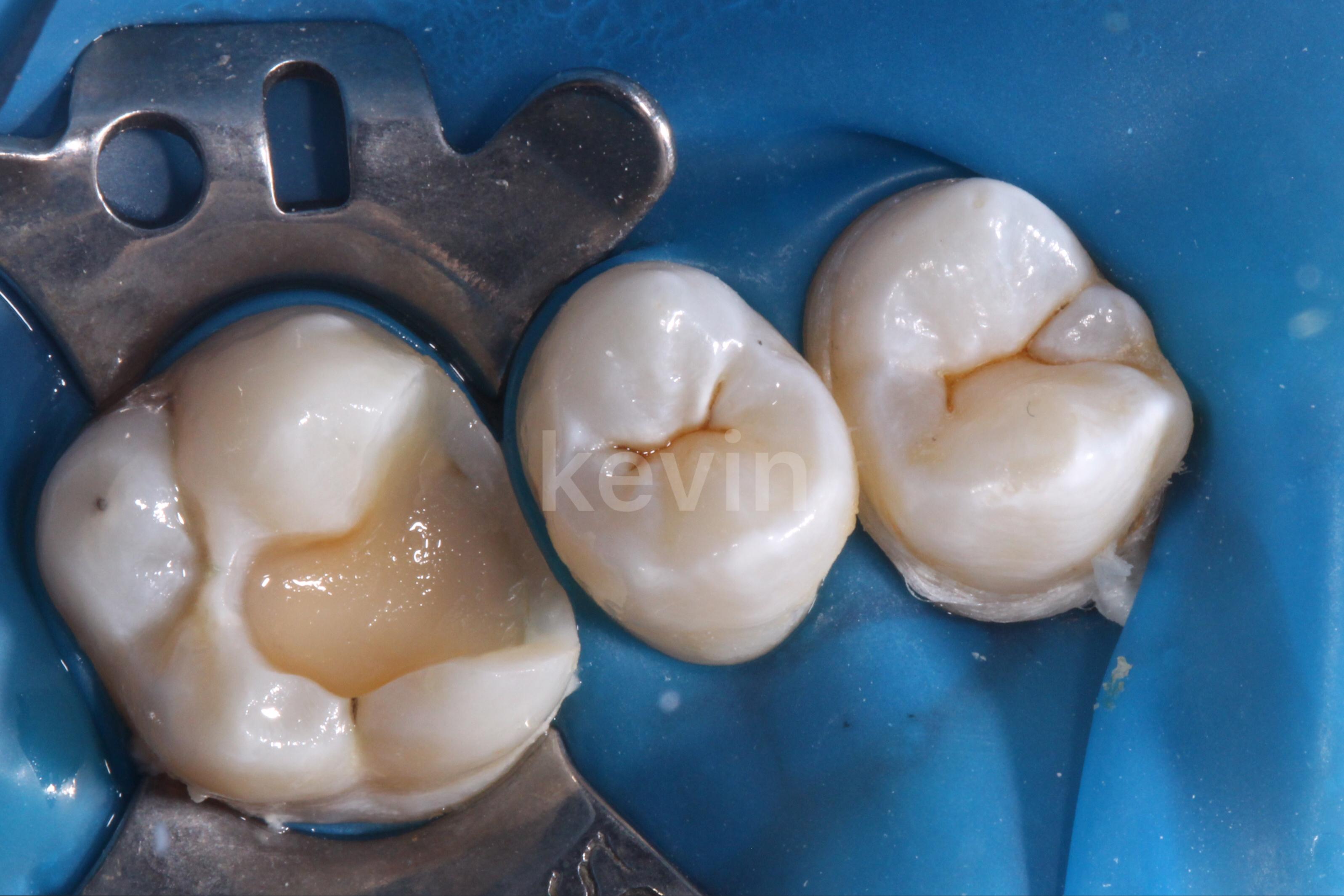 省去铸造工序，口腔技工所Proslab通过金属3D打印实现可摘局部义齿支架的数字化制造 - 3D科学谷