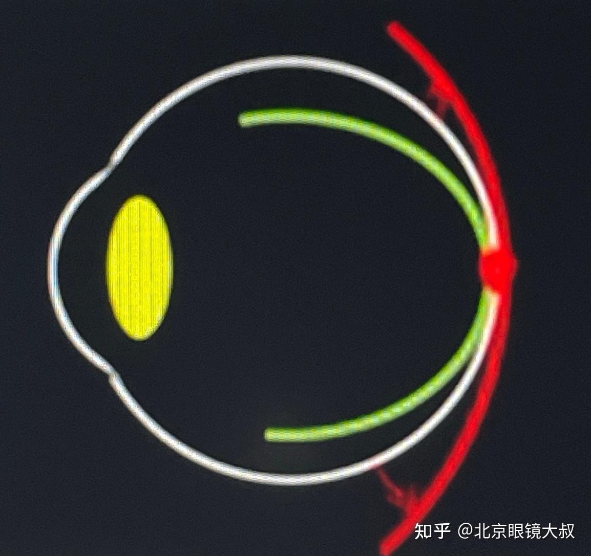 远视离焦是近视加深的元凶! - 知乎