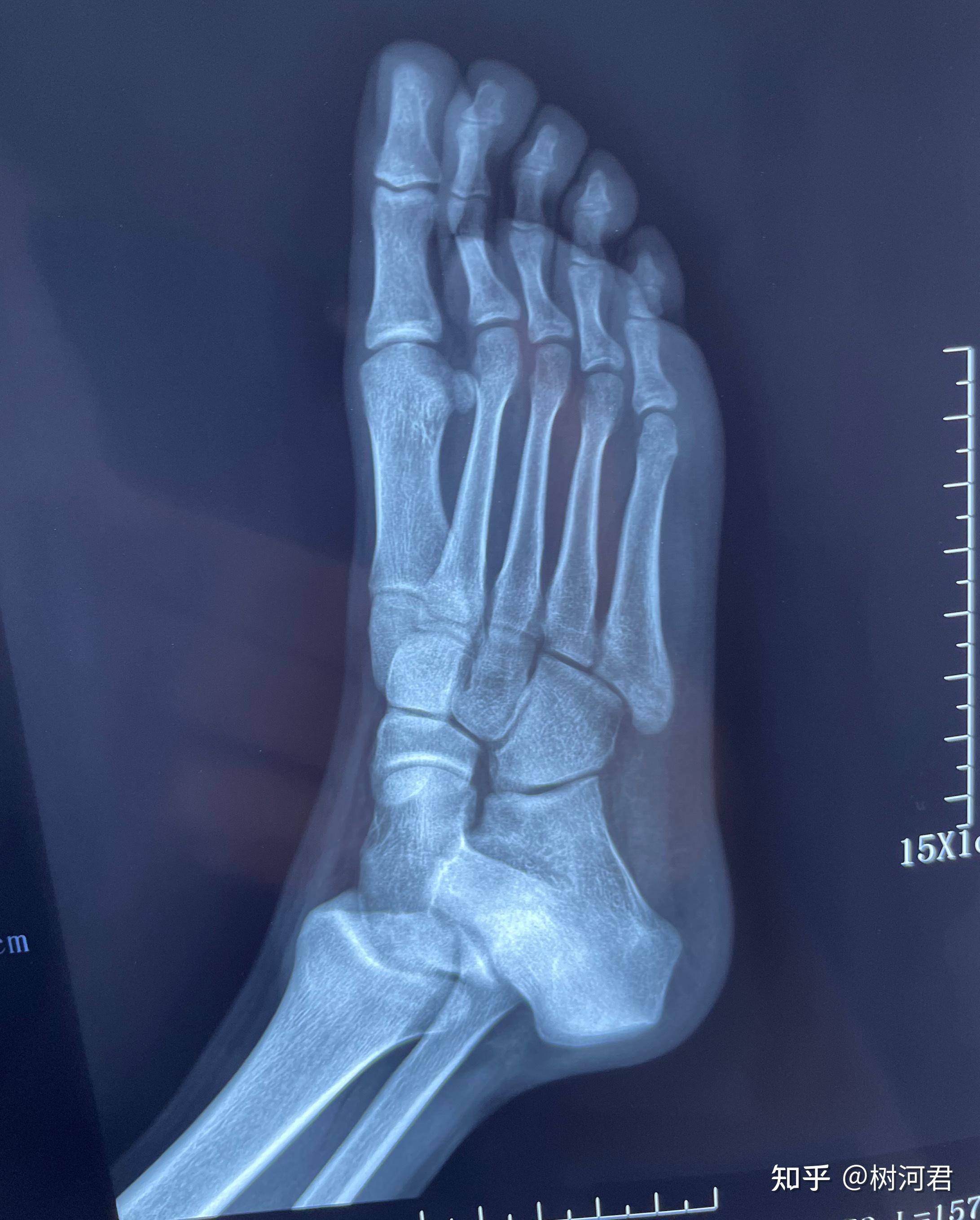 脚的第五跖骨位置图图片
