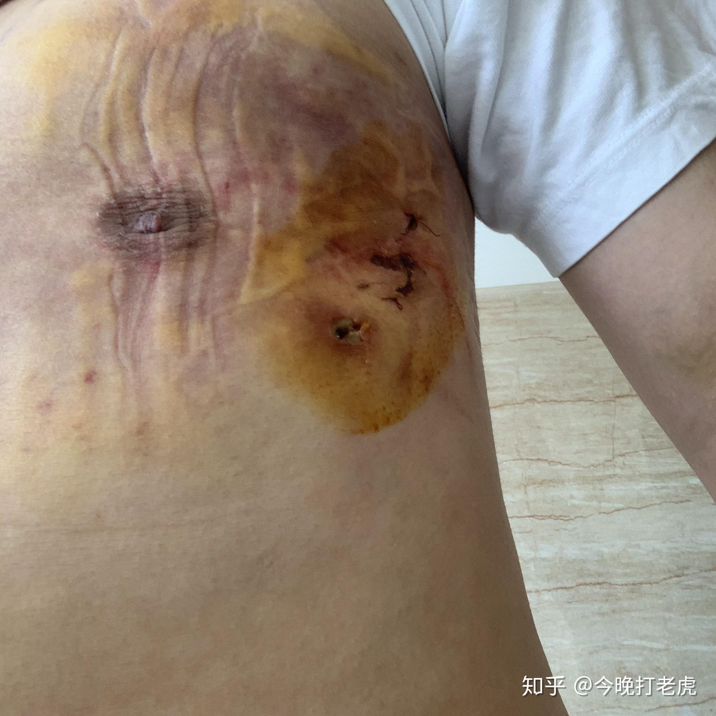 乳腺增生手术疤痕图片图片