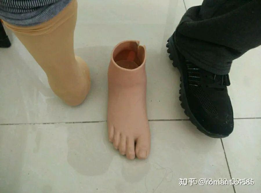 半足截肢患者选择假肢标准介绍(知乎版) - 知乎