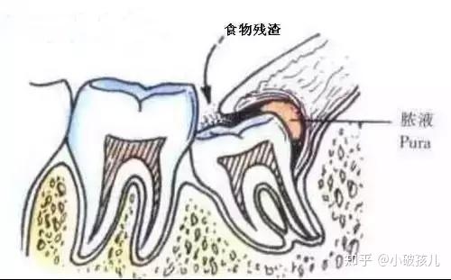 智齿冠周炎的危害及治疗方法 - 知乎
