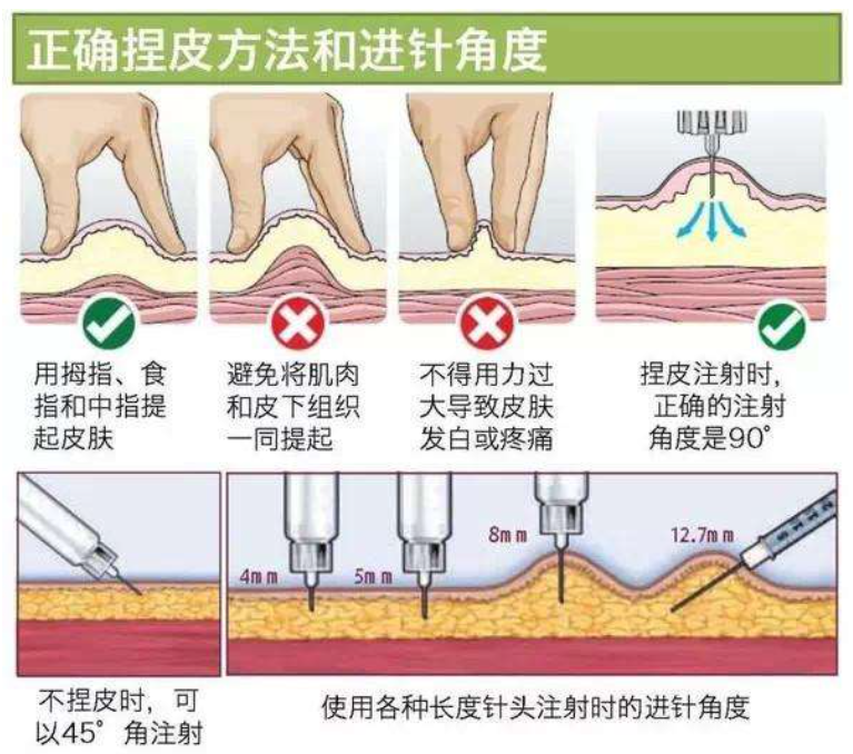 注射针头太长时,容易将胰岛素注射到肌肉组织,因为胰岛素吸收过于迅速