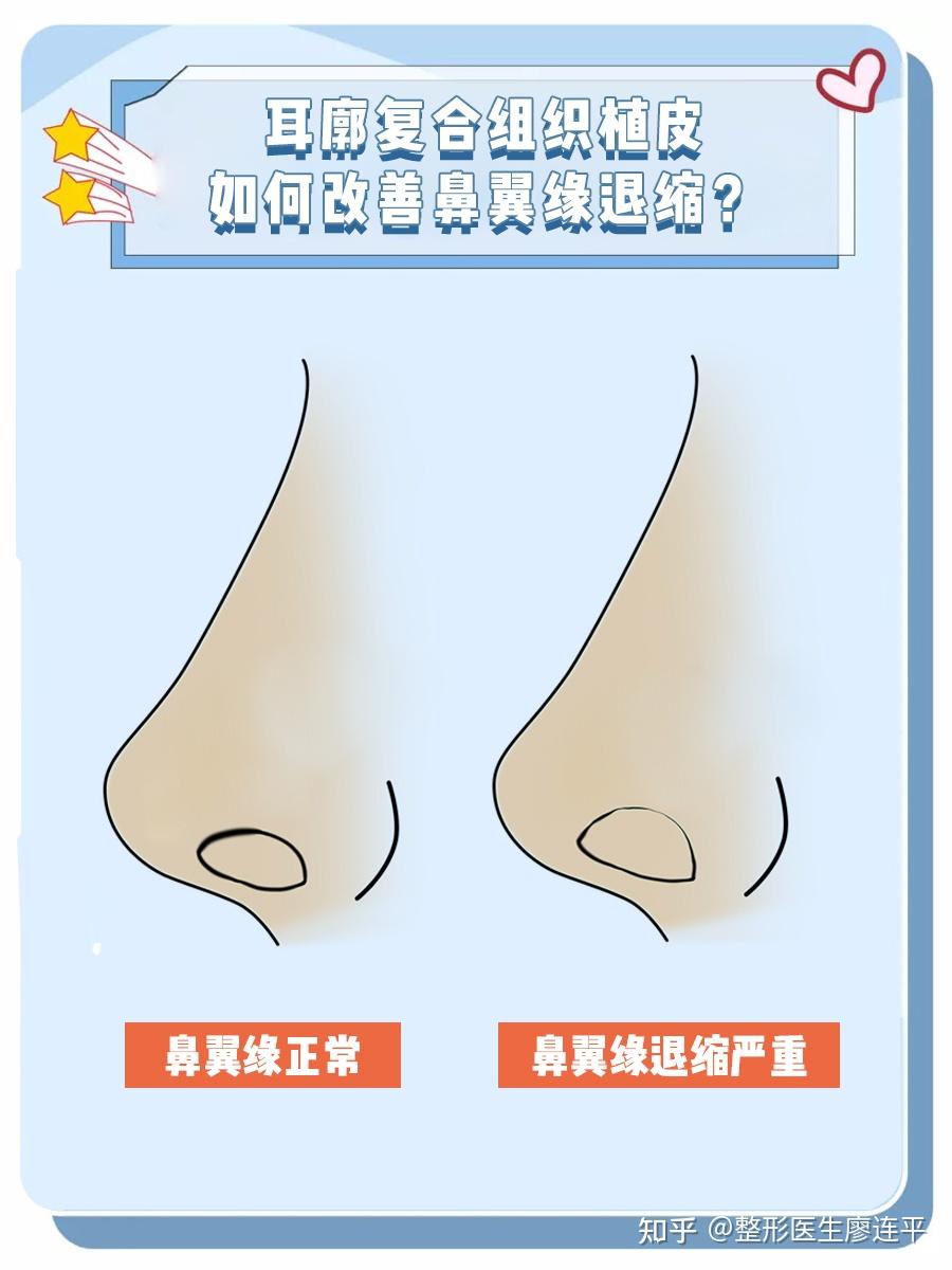 耳廓复合组织植皮如何改善鼻翼缘退缩? - 知乎