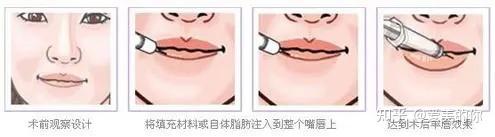 自体脂肪丰唇失败了可以修复吗? - 知乎